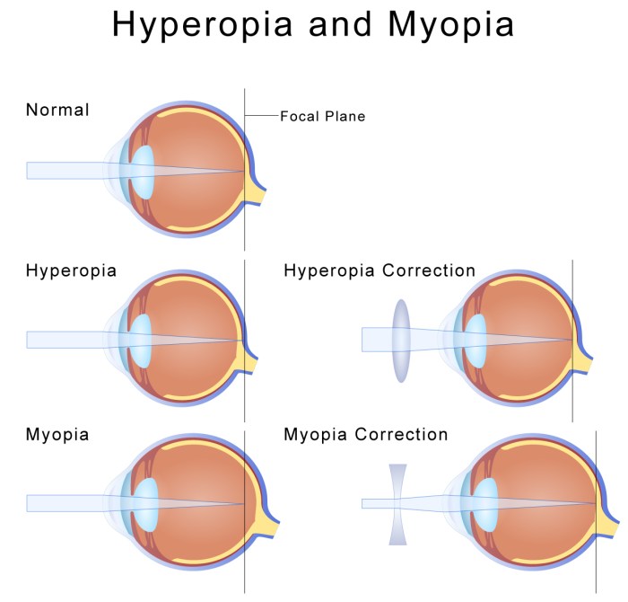 Myopia definition lord of the flies