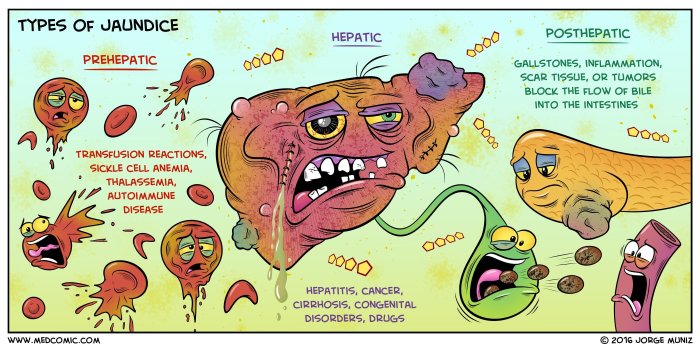 Jaundice