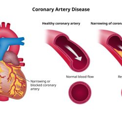 Coronary artery disease nclex questions