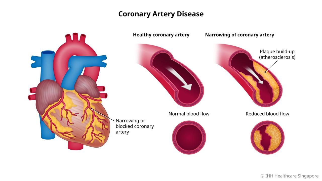 Coronary artery disease nclex questions