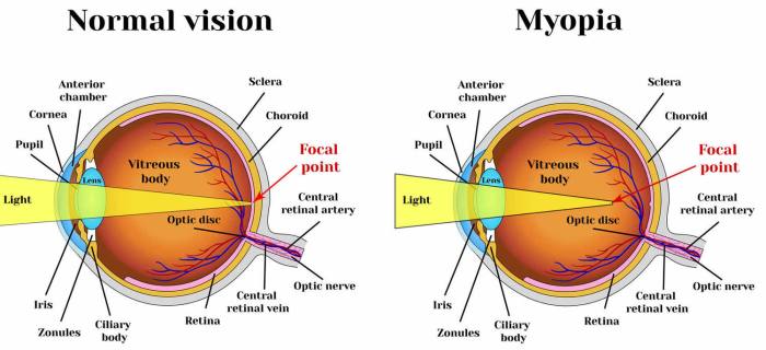 Myopia definition lord of the flies