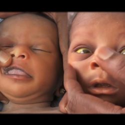 Newborn with jaundice hesi case study