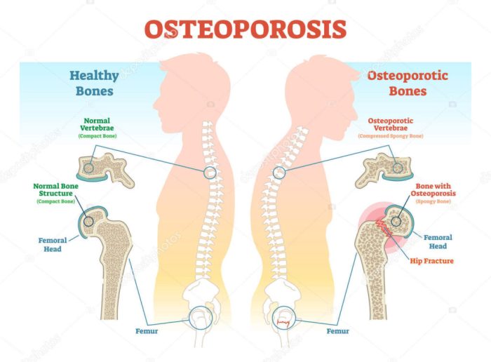 An older woman with osteoporosis presents with pain and deformity